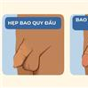 HẸP BAO QUY ĐẦU Ở TRẺ NHỎ